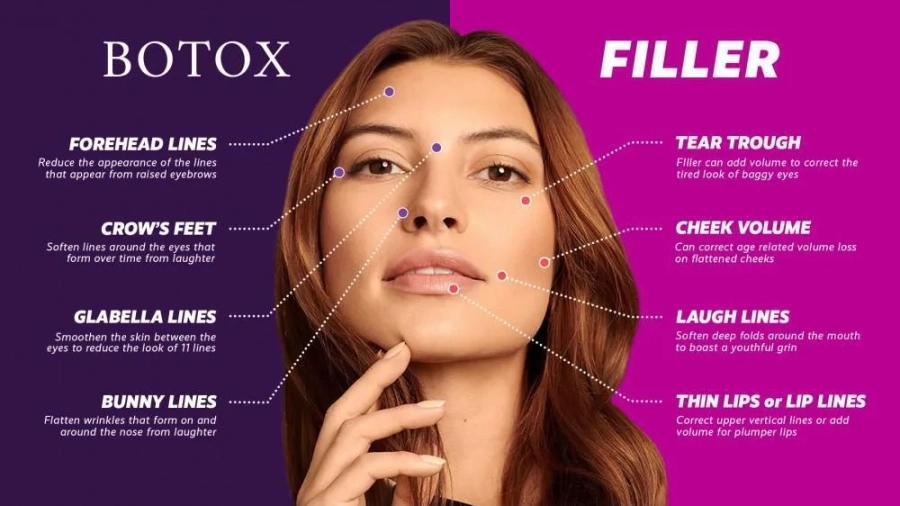 botox-fiiller